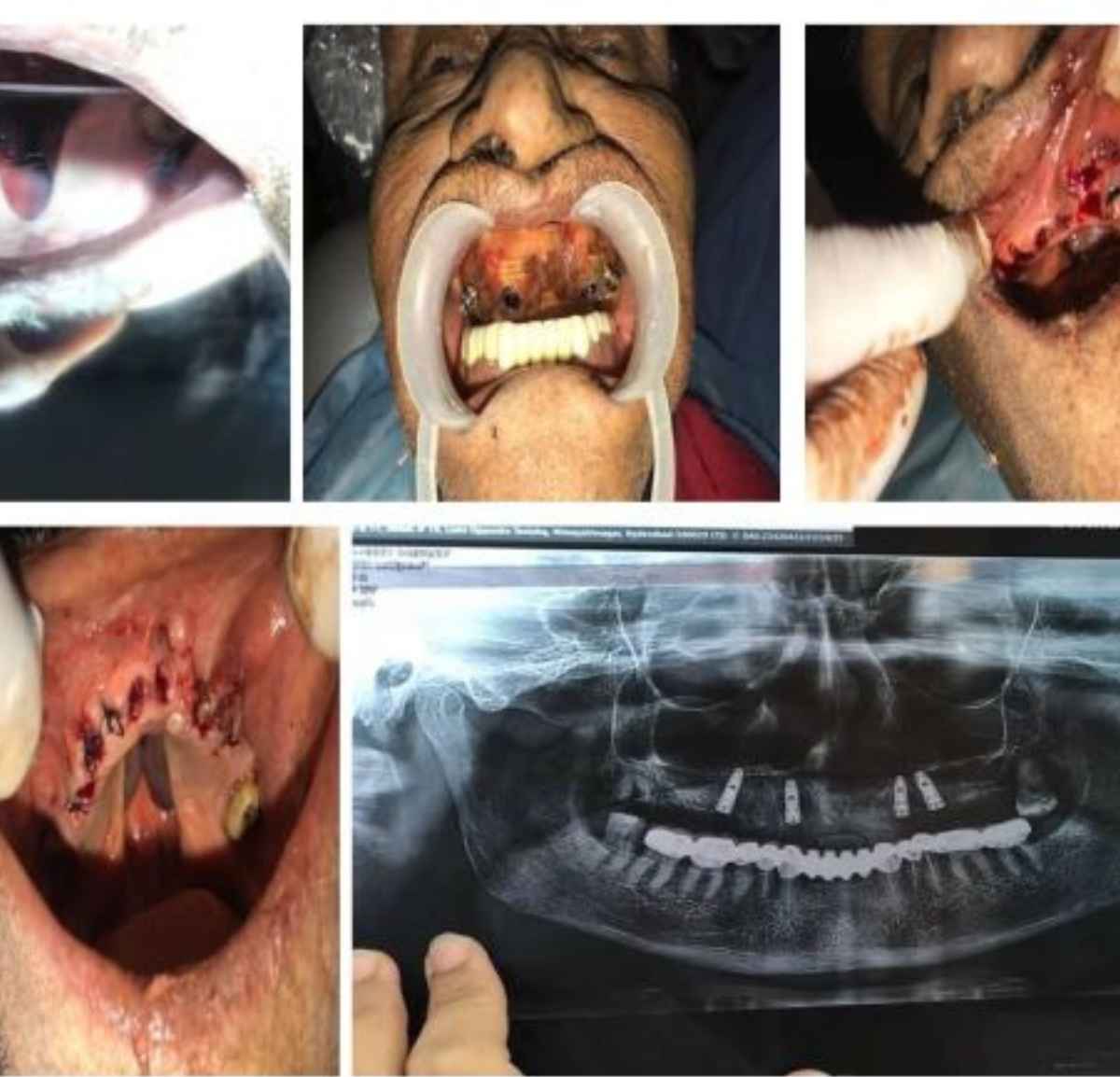 Dental Implant transformation1