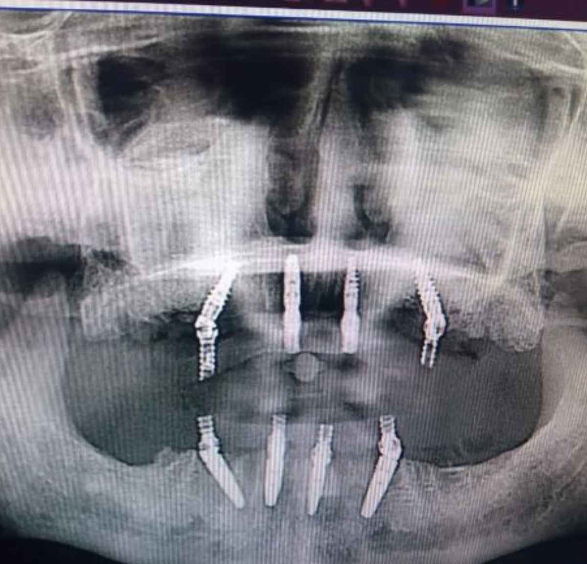 Dental Implant treatment X ray Dr shwetha's clinc