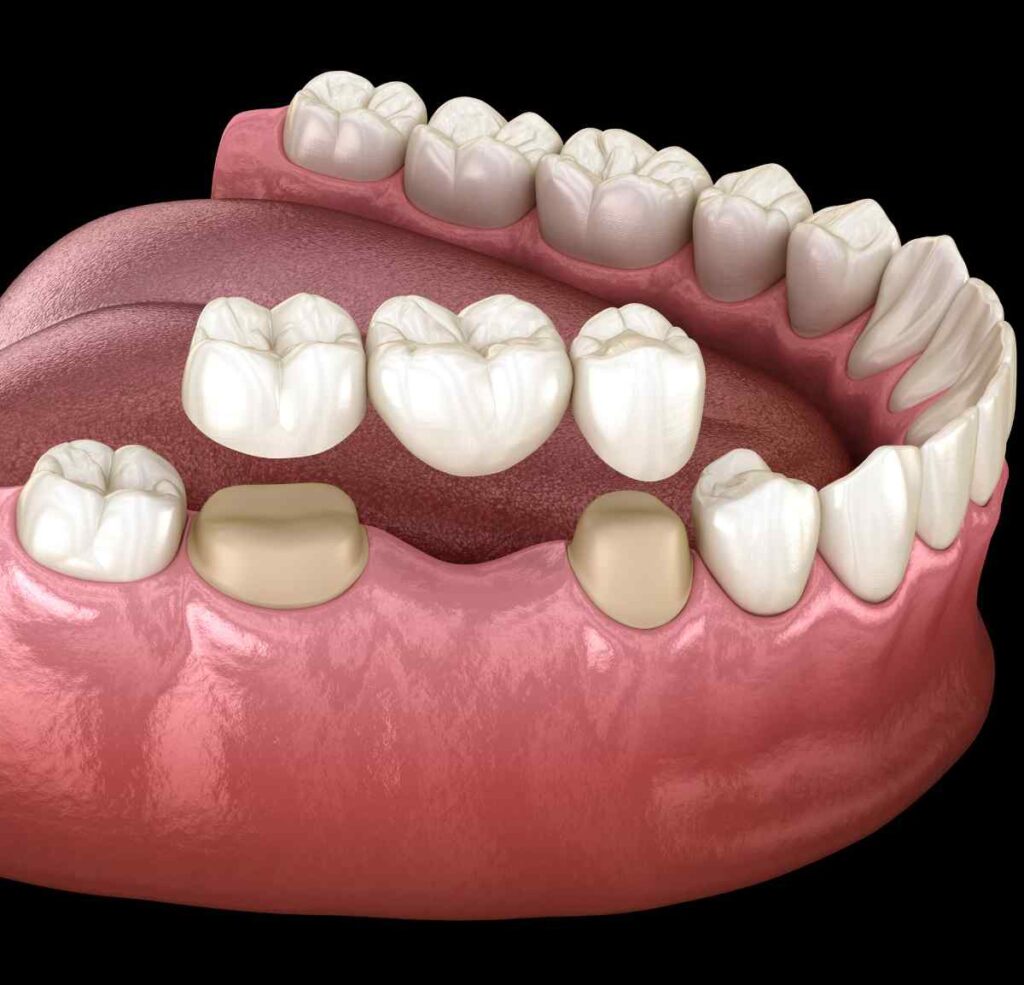 Dental bridges & Crown