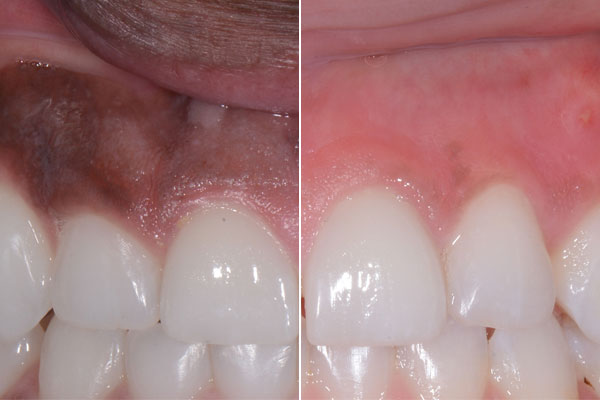 Laser-Gum-Depigmentation