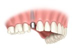 Singletooth replacementstage2