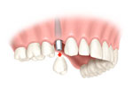 Singletooth replacementstage3