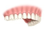 Singletooth replacementstage4