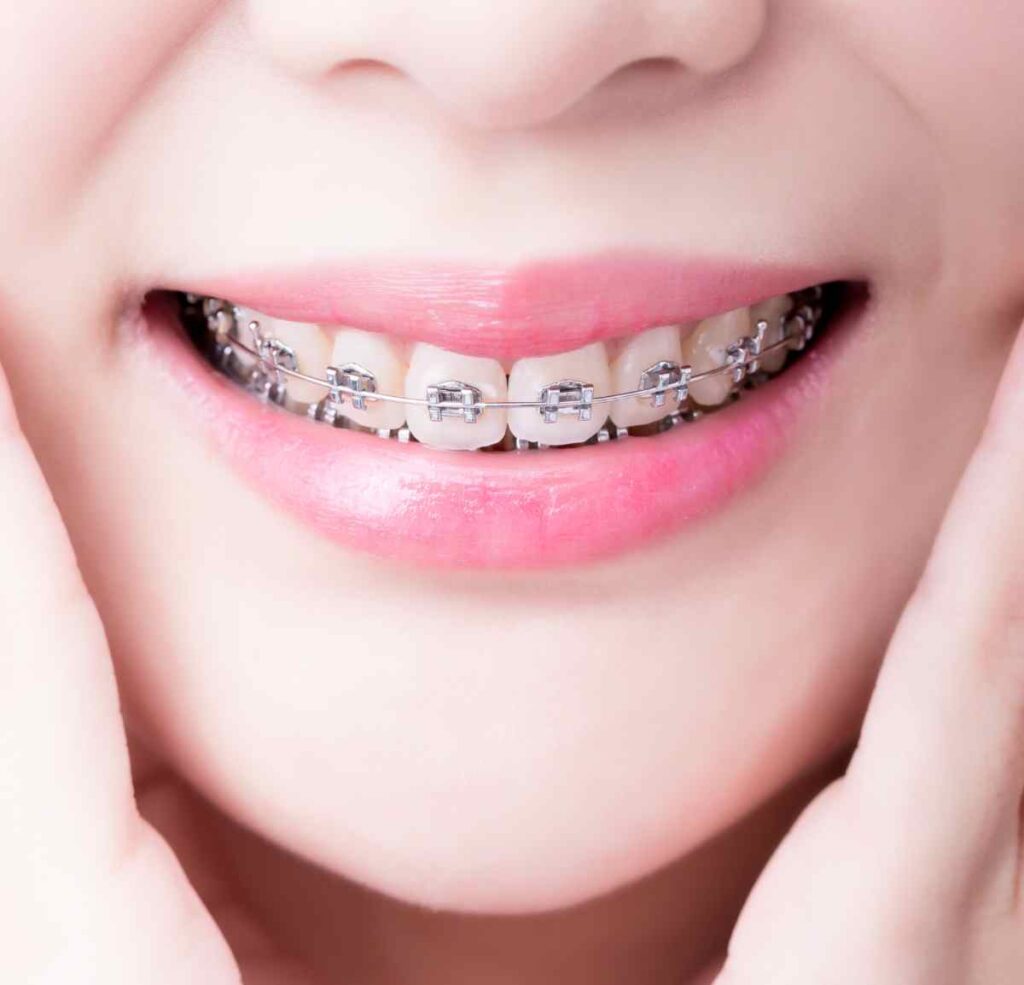 braces