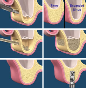 sinus-lift