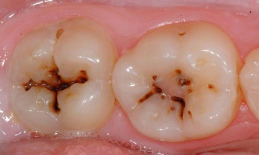 Dental caries or cavities