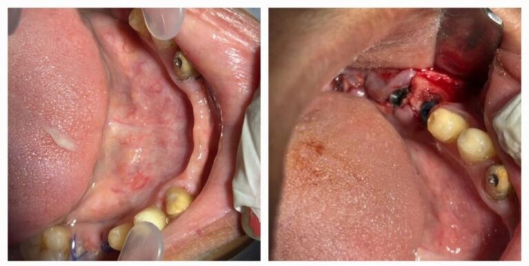 Dental Implants – Dr Shwetha