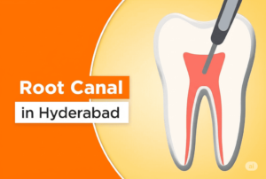 root canal treatment