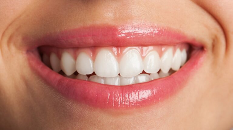 Teeth Whitening: Benefits, Methods, and Safety Tips