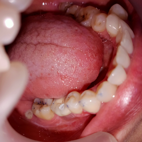 dental implant after