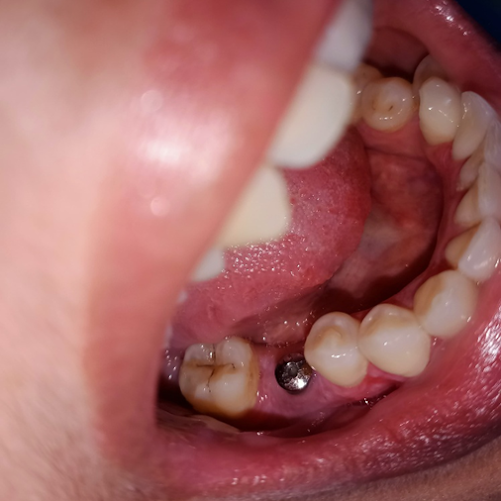 dental implant before