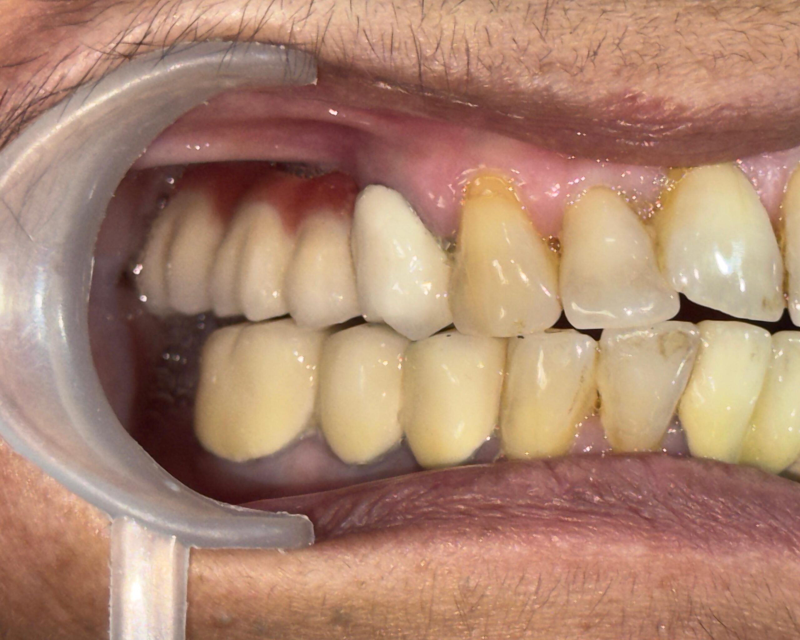 Pterygoid Implant (After)