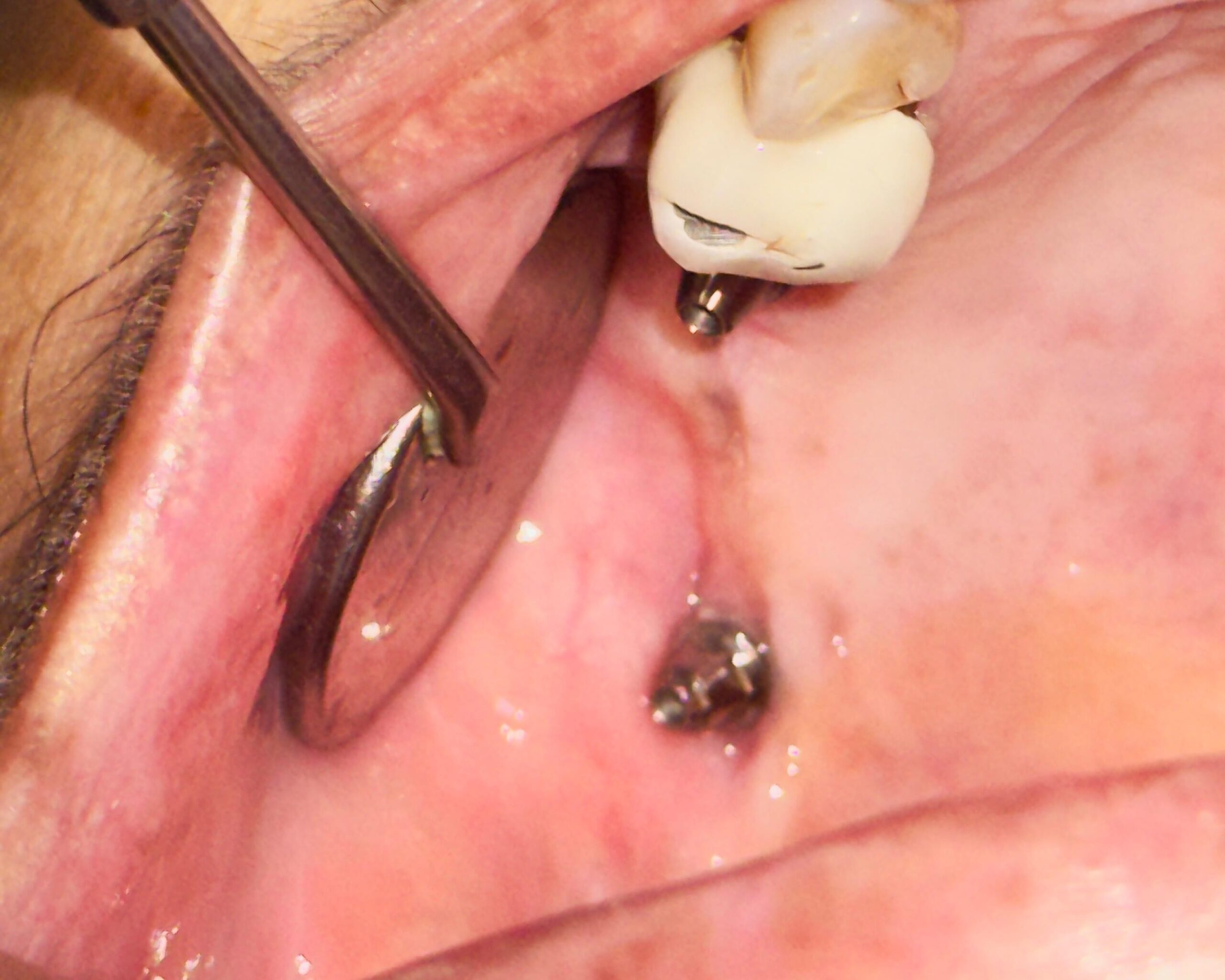 Pterygoid Implant (Before)