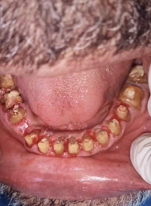 Full Mouth Rehabilitation Case 3 (Before)